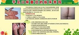 手足口病重癥臨床表現圖片