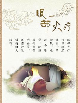 火疗