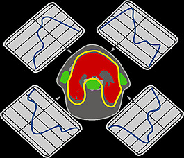 調(diào)強(qiáng)放射治療