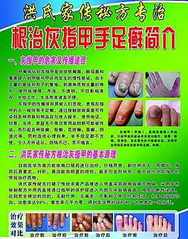 灰指甲 宣傳單