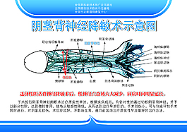 阴茎背神经降敏术示意图