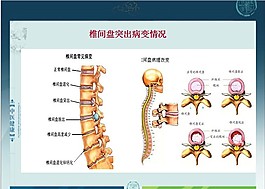 椎間盤突出病變