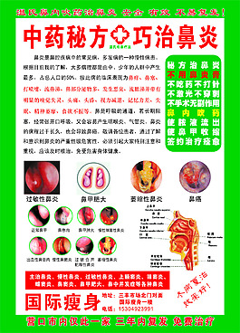 鼻炎