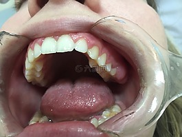 牙醫(yī),口,張開嘴