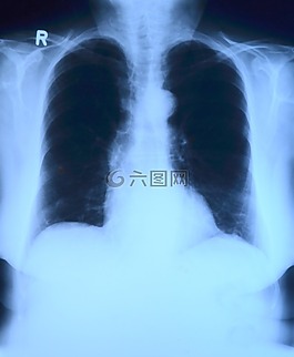 x 射線圖像,x 射線,胸部