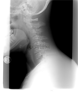 頸椎,xray,病人