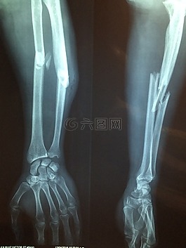 骨骼斷裂,xray,骨架