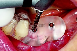 cerec,指南,两个