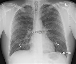 診斷,xray,胸部