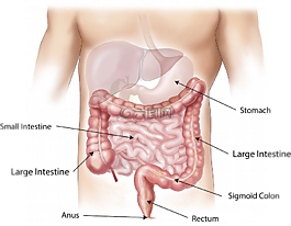 腹部,肠癌,大