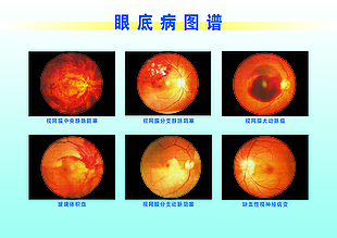 眼底病