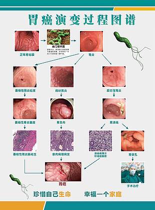 胃癌演变过程
