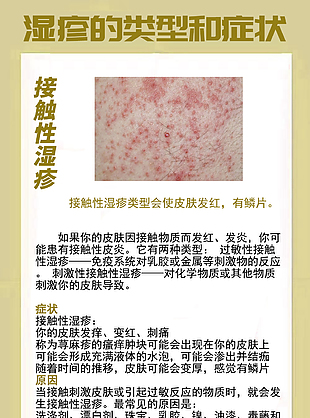 接觸性濕疹癥狀宣傳海報