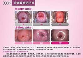 宫颈疾病治疗图片
