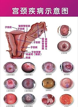 宫颈病变的早期症状图片