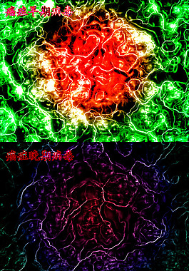 癌细胞