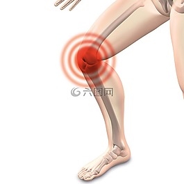arthrocalman,骨关节炎,膝关节