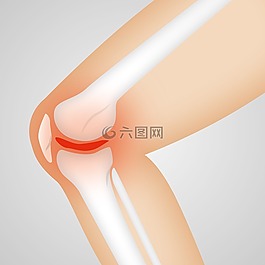 arthrocalman,骨关节炎,膝关节